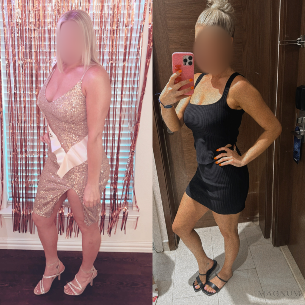 Before-and-after photo comparison shared by a Magnum Health patient receiving tirzepatide care.